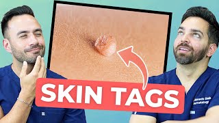 HOW TO TREAT SKIN TAGS LIKE A DERMATOLOGIST [upl. by Alemrac669]