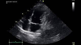 Erhlichiosis y Taponamiento Cardiaco [upl. by Thelma]