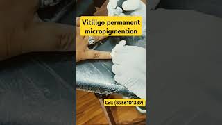 VITILIGO PERMANENT MICROPIGMENTION  VITILIGO PERMANENT TATTOO COLOURING  VITILIGO SKIN DISEASE [upl. by Stockmon474]