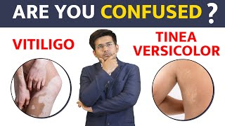 Is it Vitiligo or Tinea Versicolor  Bharat Homeopathy [upl. by Ihcego]