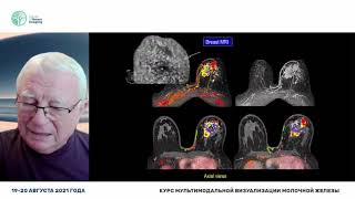 The need for multimodality approach in screening women with dense breast tissue Laslo Tabar [upl. by Gernhard]