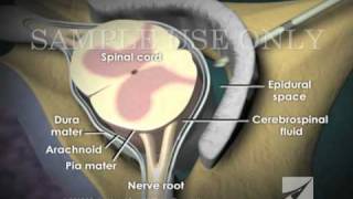 Loss of Pressure Epidural Injection [upl. by Inihor]