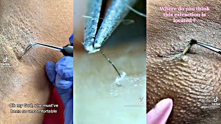 INGROWN HAIR REMOVAL COMPILATION [upl. by Allie]