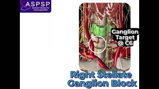 Stellate Ganglion Block [upl. by Busiek]