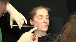 Liquid Facelift – Video Unterspritzung mit Hyaluronsäure – Zeitraffer Facelift ohne OP [upl. by Nosmirc411]