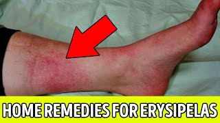 ✅ Erysipelas  erysipelas treatment  erysipelas symptoms  home remedies for erysipelas [upl. by Caputo]