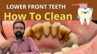 How to CLEAN Dirty Teeth at Home  Plaque Removal from Bottom Front Teeth [upl. by Nalyr]