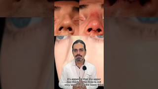 How to get fast recovery after septorhinoplasty  celebrity surgery beauty [upl. by Yrhcaz]