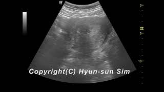 Uterus Ultrasound Uterine fibroids leiomyoma Subserosal자궁 평활근종 5 점막하 [upl. by Egiedan585]