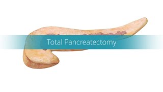 Total Pancreatectomy How the Procedure Is Performed [upl. by Enywtna]