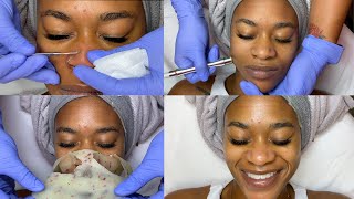 Double Exfoliation Facial w Microdermabrasion  GlamByLiaLeigh [upl. by Nickolaus]