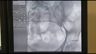 Thrombus aspiration and catheter directed thrombolysis Deepak Heart Institute [upl. by Ellehcin]