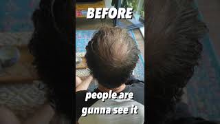 BALDING Man Gets A VIKINGS BUZZ CUT TRANSFORMATION [upl. by Erdnua644]