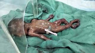 Expulsion Of Fetus At 22 Wks Of Gustation  Prematurity [upl. by Longerich960]