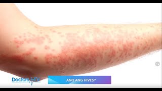 HIVES Symptoms and Treatment [upl. by Nnylyma]