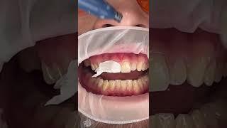 Veneers Process [upl. by Anaimad]