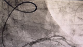 Urgent PCI in Acute Anterior MI and Lusoria Artery Tips and Tricks for Catheters Exchange [upl. by Gurtner846]