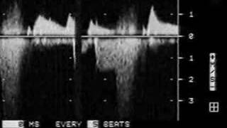 Diastolic Mitral Regurgitation [upl. by Sully]