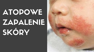 Dermatolog mówi o ATOPOWE ZAPALENIE SKÓRY [upl. by Ennoirb]