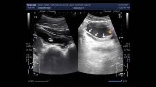 Trabeculated Urinary Bladder with a shrunken Kidney [upl. by Tabbitha640]