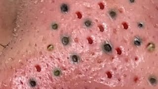 New Pimple Pops Best Pops of 2022 [upl. by Osrock]