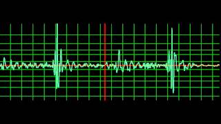 Prosthetic Valve Systolic Murmur slow [upl. by Ssitnerp102]