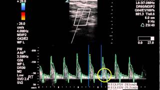 Duplex Exam of Subclavian Arterial Disease  Case Study [upl. by Cranford]