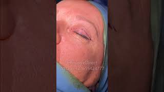 blépharoplastie Tunisie avec Chirurgiedirect chirurgie esthétique [upl. by Carilla]