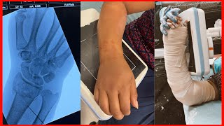 Me fracture la muñeca 😭 fotos y videos reales  Fractura de radio y cúbito [upl. by Riancho]