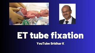 ET tube fixation l How to fix tube securely in babies [upl. by Hermine972]