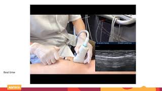 Ultrasound guided foam sclerotherapy with needle [upl. by Campney81]