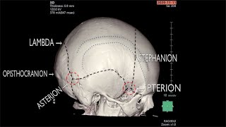 Sutures amp craniometric points of the skull frontal and lateral surface [upl. by Micheline279]