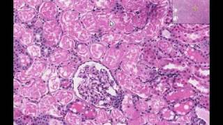 Histopathology Kidney Acute tubular necrosis [upl. by Crofton15]