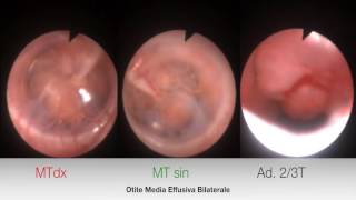 Otite media catarrale diagnosi endoscopica in paziente pediatrico [upl. by Marketa]