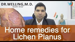 Simple Home Remedies To Get Rid Of Lichen Planus [upl. by Mannie]