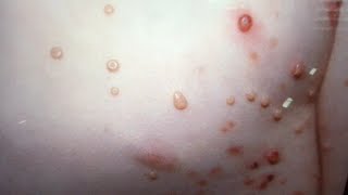 Molluscum Contagiosum PopTALK Dermatology diagnosis discussion [upl. by Kravits]