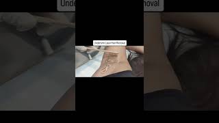 Underarm Laser Hair Removal [upl. by Llenyaj]