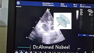 VSD OCCLUDER by an echocardiography insitu 🫀 hearthealth echocardiogram echocardiography heart [upl. by Daune]