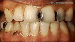 GV Blacks Classification of Dental Caries [upl. by Tiossem]