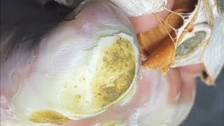 Pedicure video25，vertical plantaris，plantar wart [upl. by Erised857]