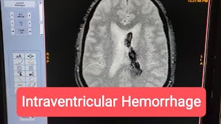 How to Diagnose Intraventricular Hemorrhage on MRI of Brain [upl. by Brader95]