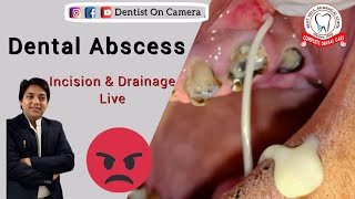 Huge Dentals abscess incision amp drainage [upl. by Harold547]