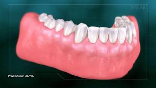 Gingivitis  Inflamed Gums [upl. by Atiram]