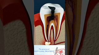 Root Canal Treatment Explained  How to Treat a Tooth Abscess Shorts [upl. by Gabrielle]