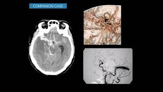 Imaging subarachnoid hemorrhage [upl. by Haldi]