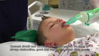 Paediatric Anaesthetics Chapter 2  LMA insertion 1 [upl. by Ipoillak]