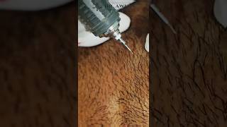 White Beard Removal Treatment By Fue Method  White Beard Permanent Solution  whitebeard [upl. by Swords576]