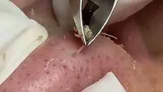 Tweezer Triumph Massive Nose Blackhead Removal [upl. by Rinee]