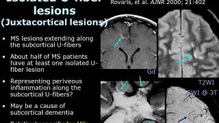 ISMRM MR Academy Acute Demyelination [upl. by Nycila148]