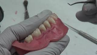 Gingival Recontouring [upl. by Atteynek]